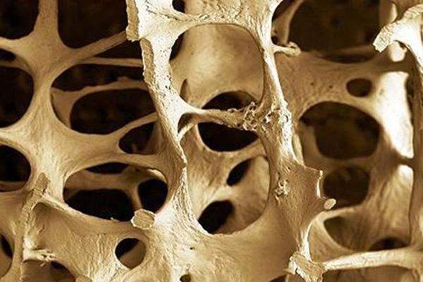 The ageing population is at a greater risk of osteoporosis